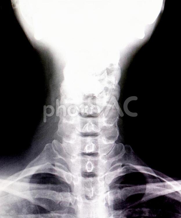 頸部 X 光片 0505, x-射線, 鞭打, 首, JPG